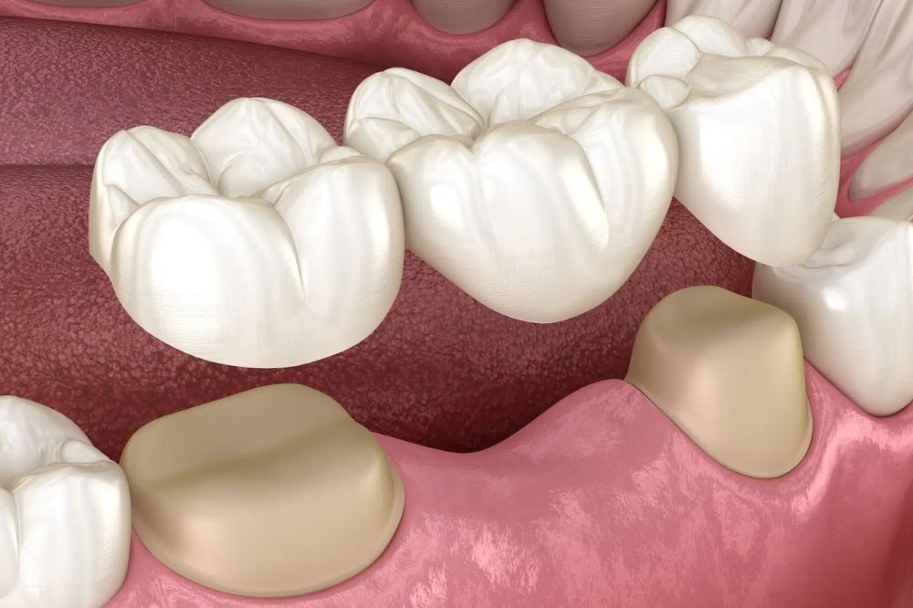 Dental Bridges